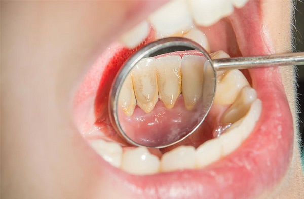 Cách lấy cao răng tại nhà 1 1