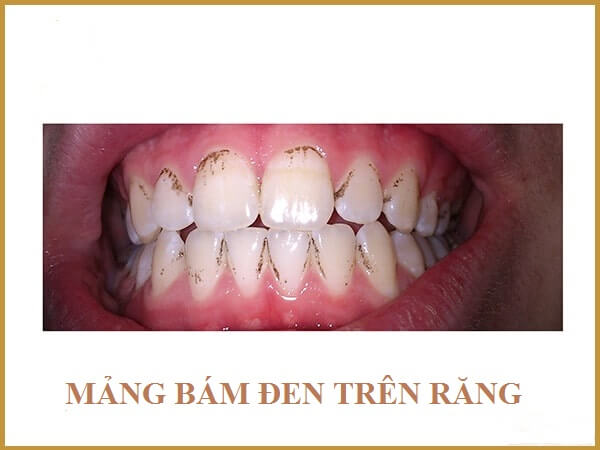 Mảng bám đen trên răng 1