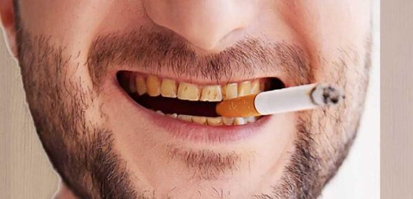 Mảng bám đen trên răng 2