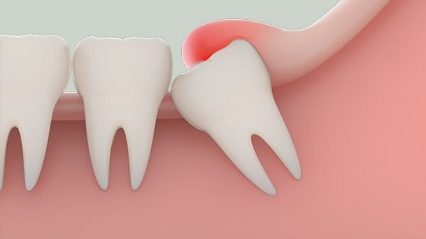 Dấu hiệu mọc răng khôn 1