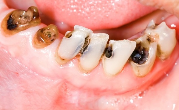 Mới nhổ răng khôn nên ăn gì 1