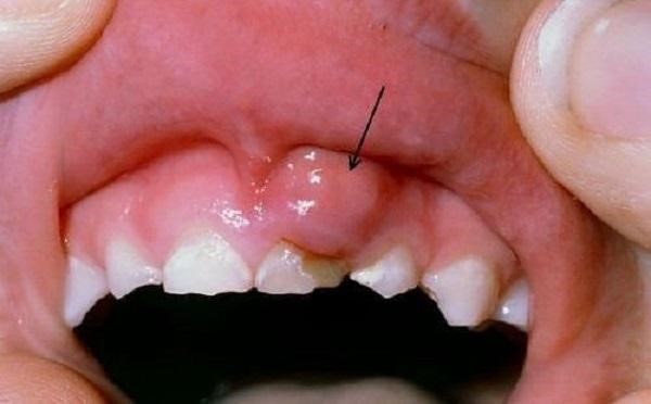 Mới nhổ răng khôn nên ăn gì 2
