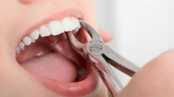 Cách cầm máu khi nhổ răng 0 1
