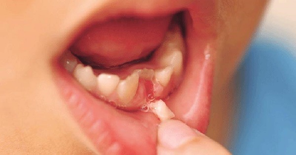 Cách cầm máu khi nhổ răng 2