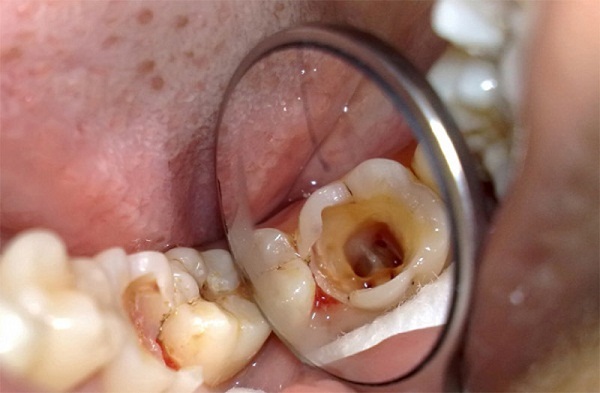 Cách trị đau răng 0