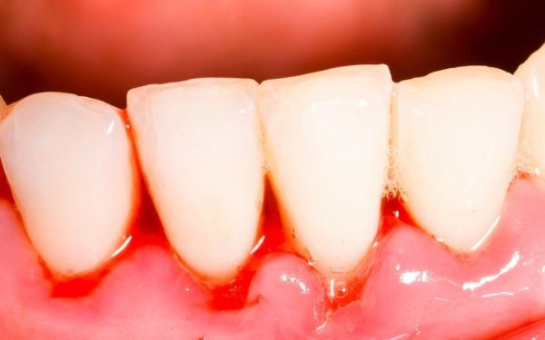 Chảy máu chân răng là bệnh gì 0