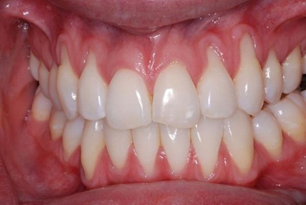 Chảy máu chân răng là bệnh gì 2