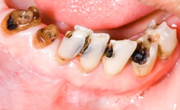 Chảy máu chân răng là bệnh gì 3