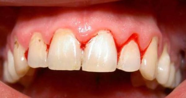 Chảy máu chân răng là bệnh gì 4