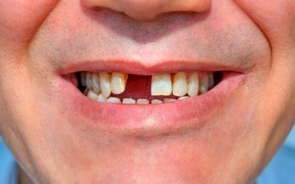 Chảy máu chân răng là bệnh gì 5