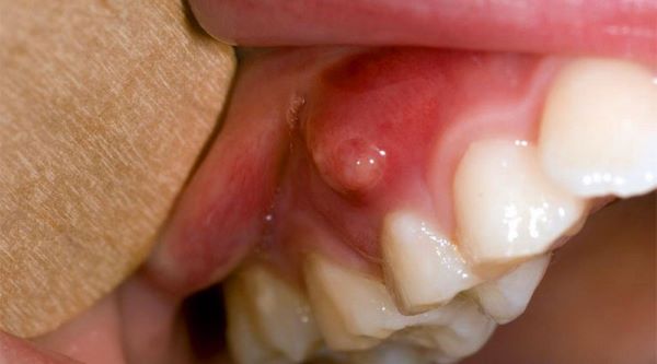 Chảy máu chân răng là bệnh gì 6