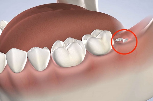 Dấu hiệu răng khôn mọc lệch 0