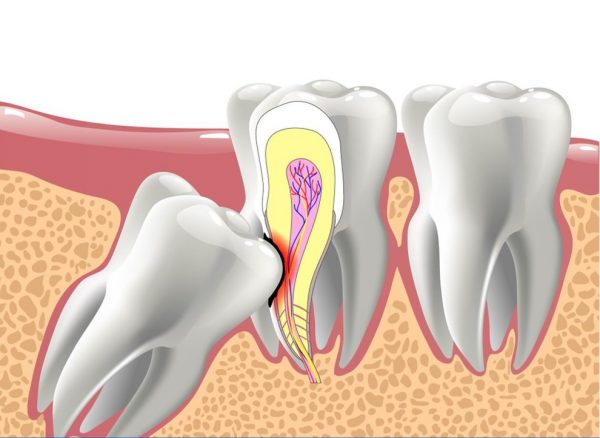 Dấu hiệu răng khôn mọc lệch 1
