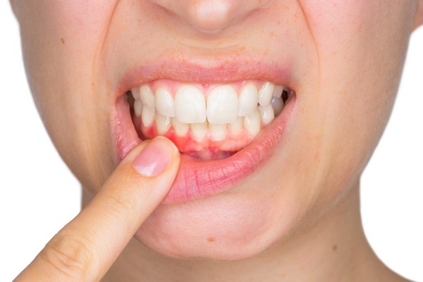 Dấu hiệu răng khôn mọc lệch 4