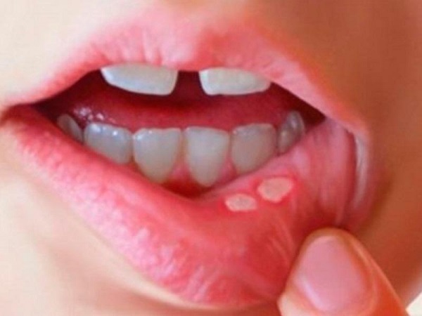 Hay bị nhiệt miệng là dấu hiệu của bệnh gì 0