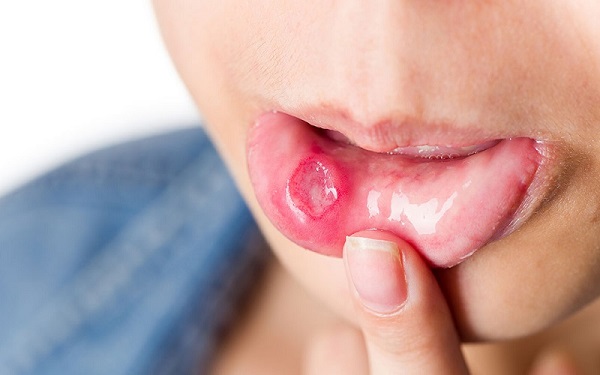 Hay bị nhiệt miệng là dấu hiệu của bệnh gì 1