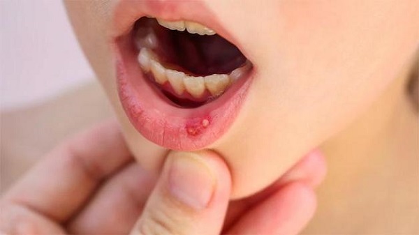 Hay bị nhiệt miệng là dấu hiệu của bệnh gì 2