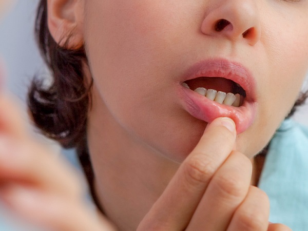 Hay bị nhiệt miệng là dấu hiệu của bệnh gì 3