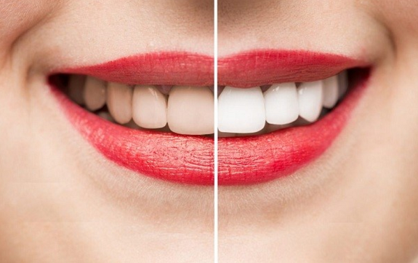 Tẩy trắng răng có hại không 1