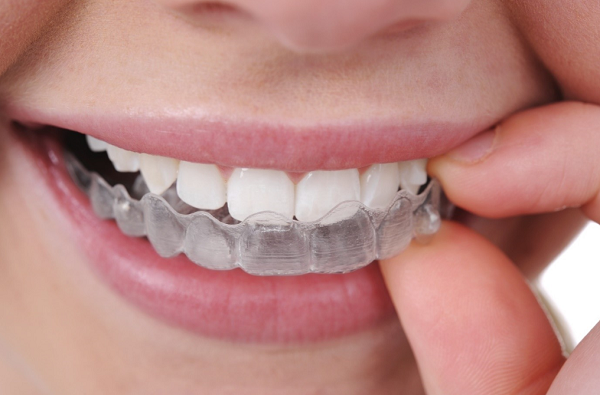 Tẩy trắng răng có hại không 2