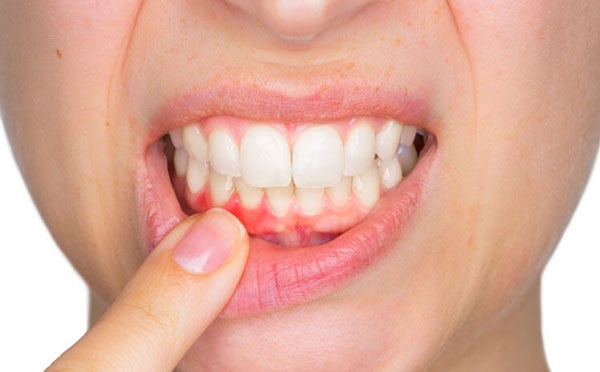 Cách trị sưng nướu 1