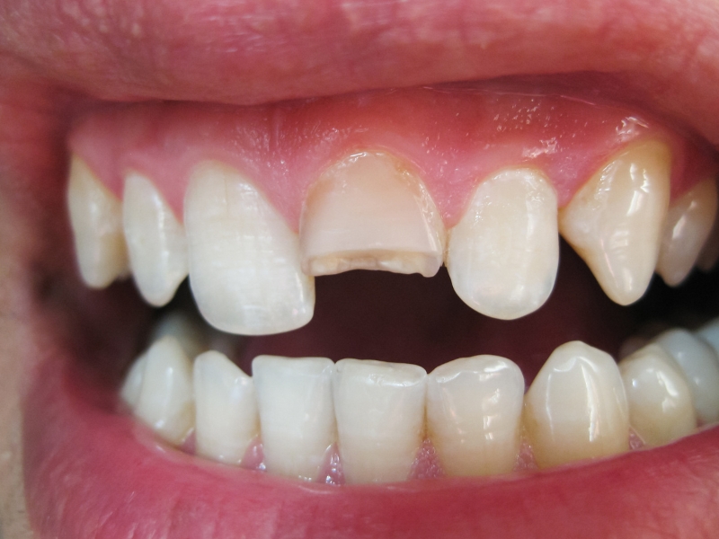 1 tìm hiểu một số nguyên nhân gây vỡ răng 1