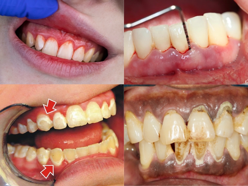 2 dấu hiệu của bệnh viêm nha chu