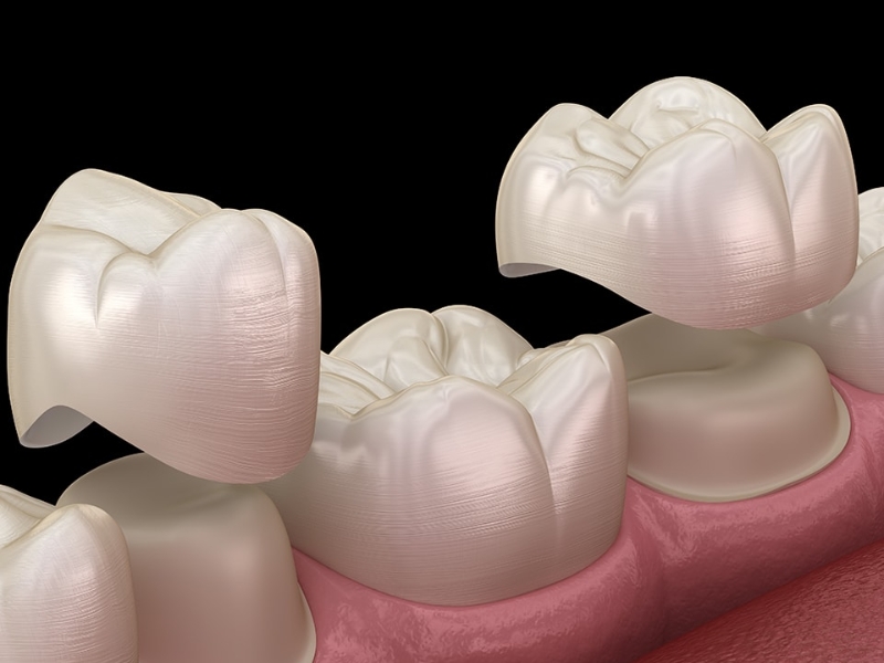 4 phương pháp bọc sứ khi răng bị vỡ mòn lớn