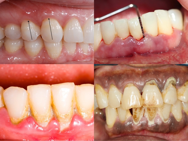 5 các giai đoạn của bệnh viêm nha chu