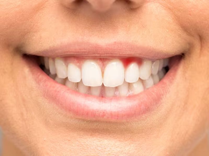 4 viêm nướu răng