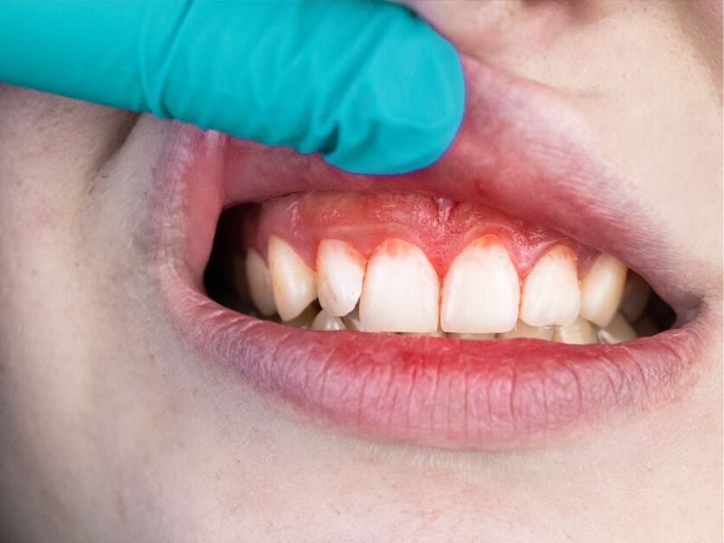 7 viêm nướu răng