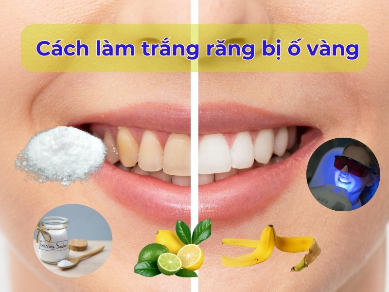 2 các cách tẩy trắng răng bị ố vàng 1
