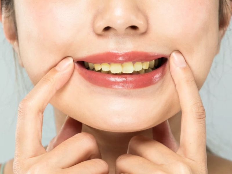 3 răng bị xỉn màu