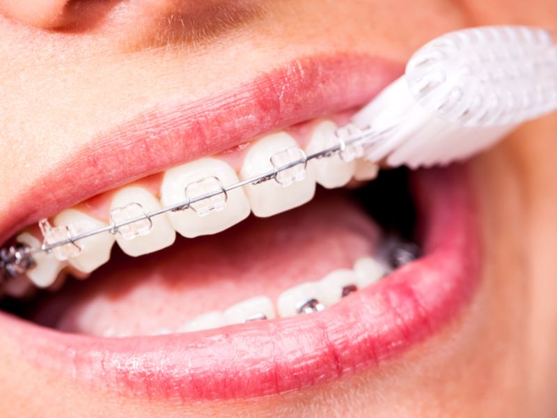 11 bộ dụng cụ vệ sinh răng niềng