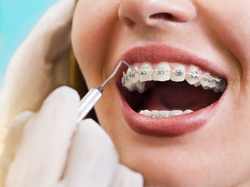 2 bộ dụng cụ vệ sinh răng niềng