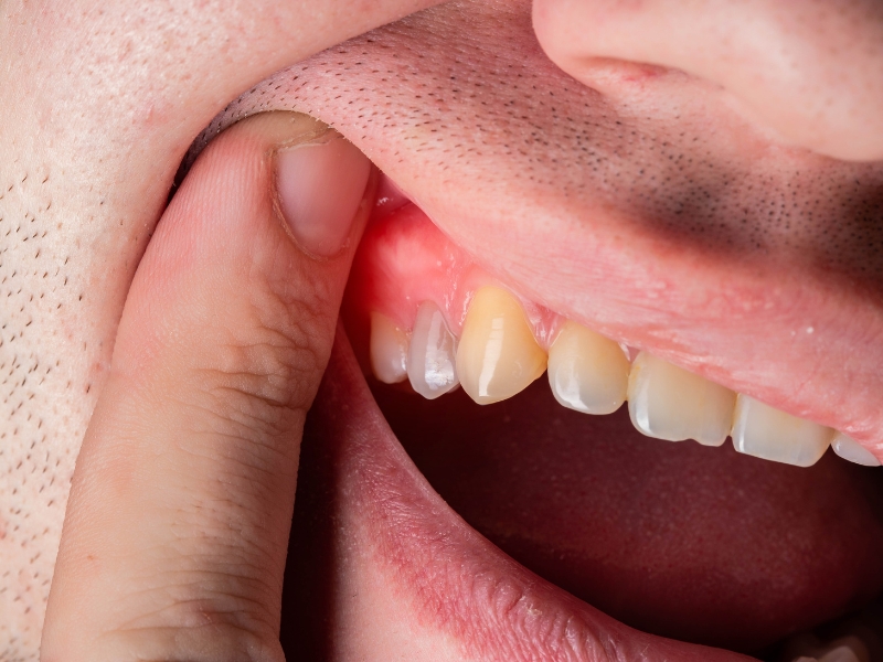 2 tình trạng tích tụ mủ trong mô quanh răng do nhiễm trùng 1
